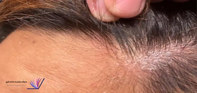 عفونت قارچی مو