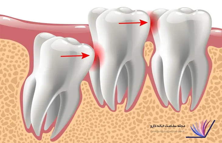 دندان عقل چیست؟ و کجاست؟