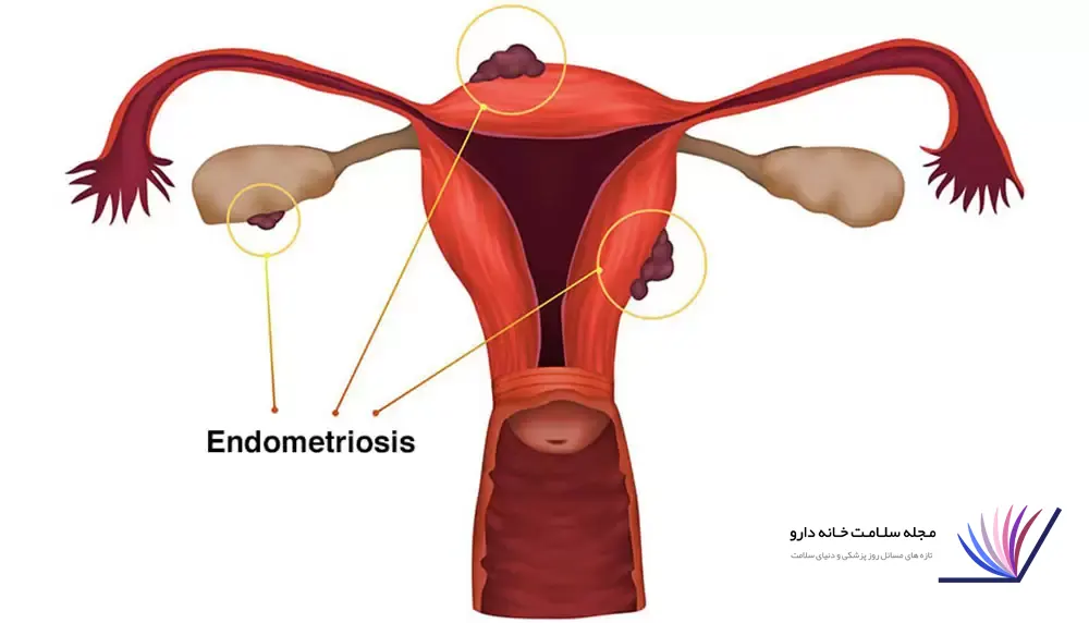 بیماری آندومتريوز چیست